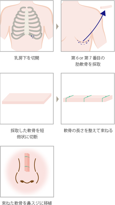 肋軟骨移植