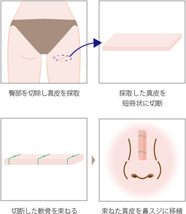 真皮移植