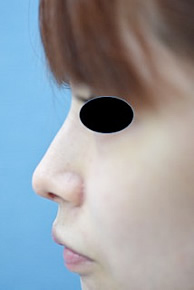 「鼻尖鼻耳介軟骨移植（単独手術）」の症例写真・ビフォーアフター