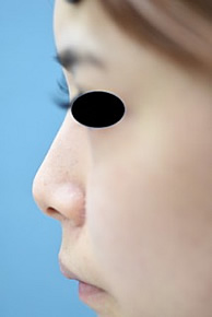 「鼻尖鼻耳介軟骨移植（単独手術）」の症例写真・ビフォーアフター