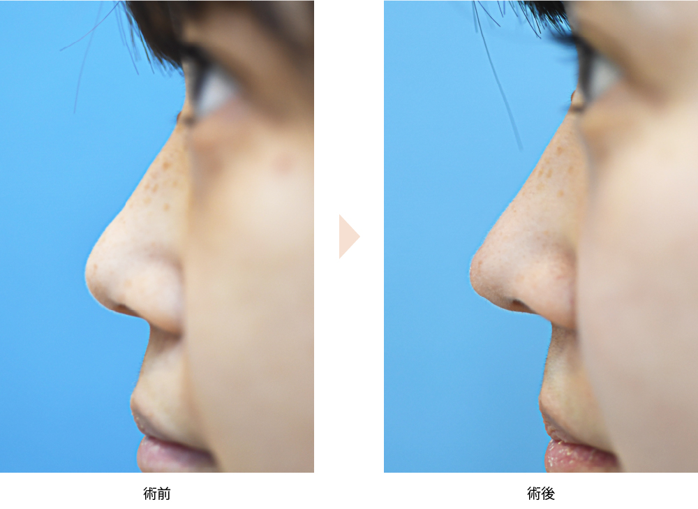 「鼻尖耳介軟骨移植（クイック法／クローズドアプローチ）」の症例写真・ビフォーアフター