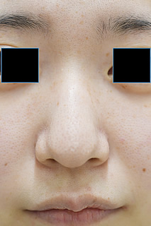 「鼻尖修正＋ハンプ除去（忘れ鼻整形）」の症例写真・ビフォーアフター