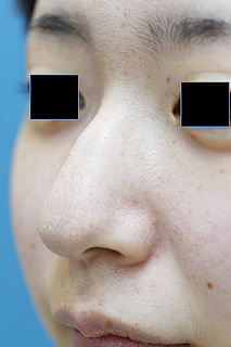 「鼻尖修正＋ハンプ除去（忘れ鼻整形）」の症例写真・ビフォーアフター