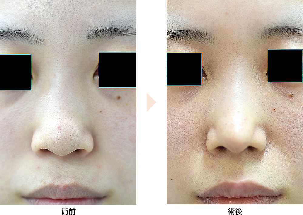 「鼻尖修正（鼻先を違和感のない自然な形で細くする）」の症例写真・ビフォーアフター