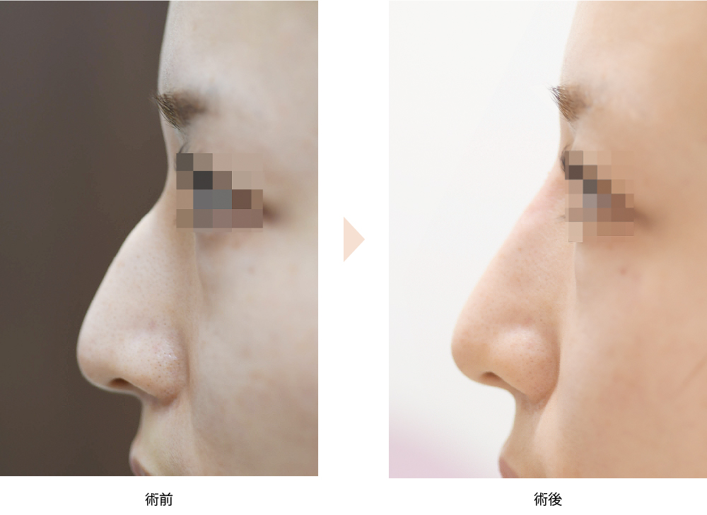 「ヒアルロン酸によるワシ鼻修正術（手術不要）」の症例写真・ビフォーアフター