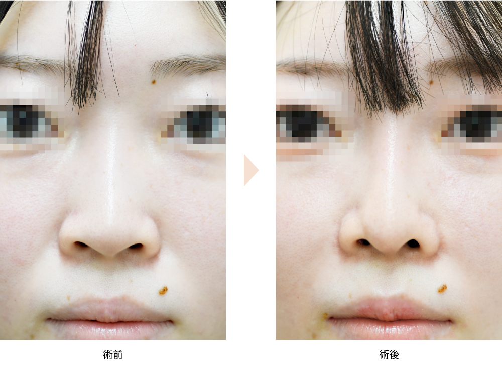 「貴族手術（鼻翼基部プロテーゼ／鼻孔内アプローチ）」の症例写真・ビフォーアフター