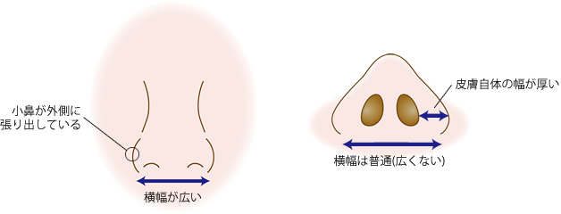 小鼻（鼻翼）の皮膚に厚みがある状態