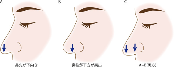 矢印鼻は垂れさがっている部分によって原因・治療法が異なる
