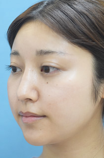 「鼻筋を細く見せる複合手術（プロテーゼ・鼻尖縮小・鼻中隔延長など）」の症例写真・ビフォーアフター
