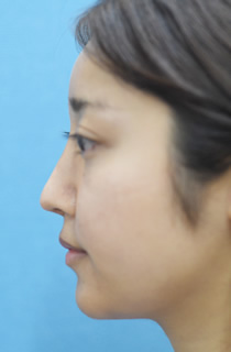 「鼻筋を細く見せる複合手術（プロテーゼ・鼻尖縮小・鼻中隔延長など）」の症例写真・ビフォーアフター