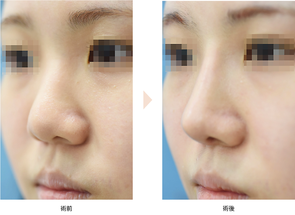 「魅せ鼻整形（プロテーゼ・鼻中隔延長）」の症例写真・ビフォーアフター