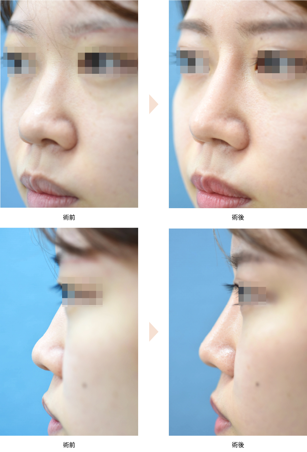 「鼻スジのわずかな歪み・うねりを整えるプロテーゼ術」の症例写真・ビフォーアフター