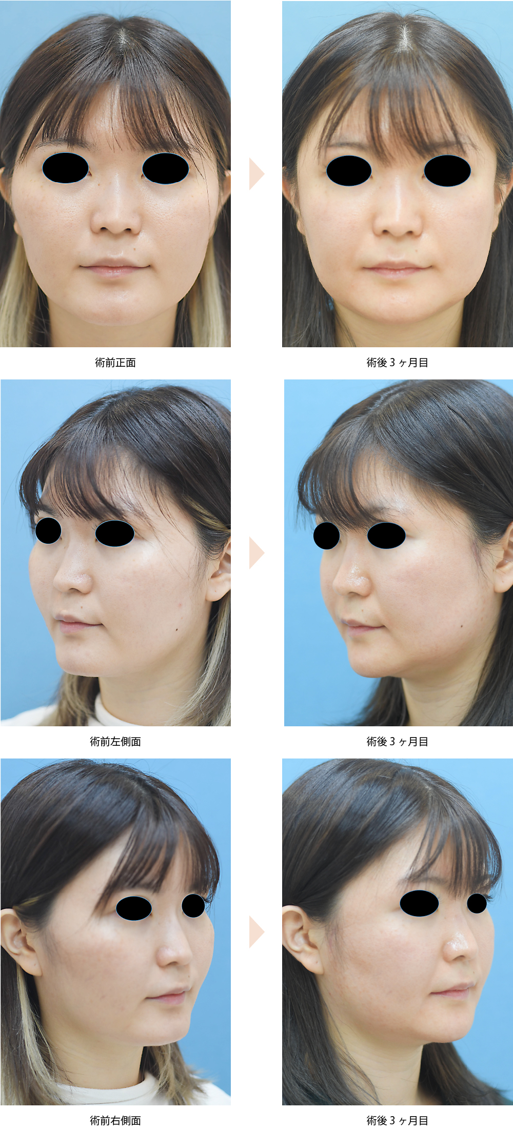 「頬骨整形／頬骨骨切り・骨削り術（体部＋弓部／頬の突出・顔の余白改善）」の症例写真・ビフォーアフター