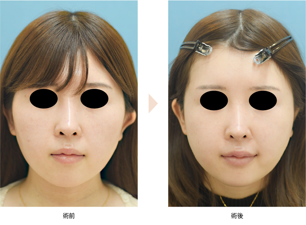 「頬骨骨削り＋骨切り術（体部＋弓部／顔の余白・ゴツゴツ感の改善）」の症例写真・ビフォーアフター