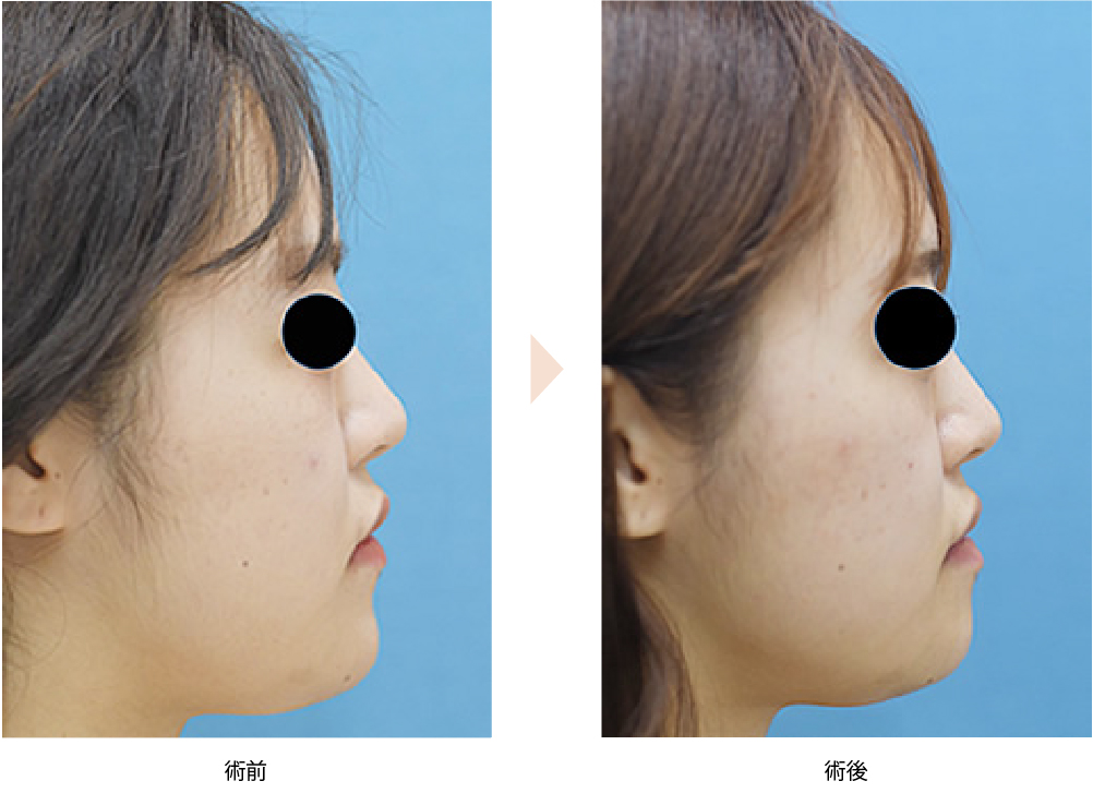 「おとがい骨切り術／顎の短縮・左右非対称改善」の症例写真・ビフォーアフター