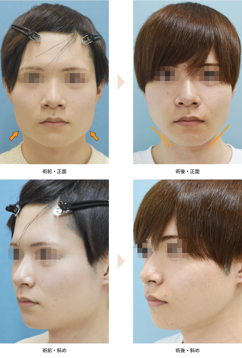 「エラ骨切り・下顎下縁形成術（エラ張りを複合施術で改善）」の症例写真・ビフォーアフター