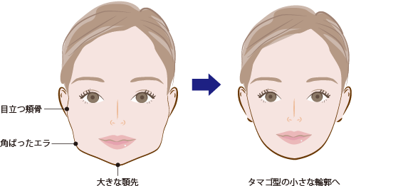 輪郭3点セットは小顔効果が得られるベーシックな小顔整形術です