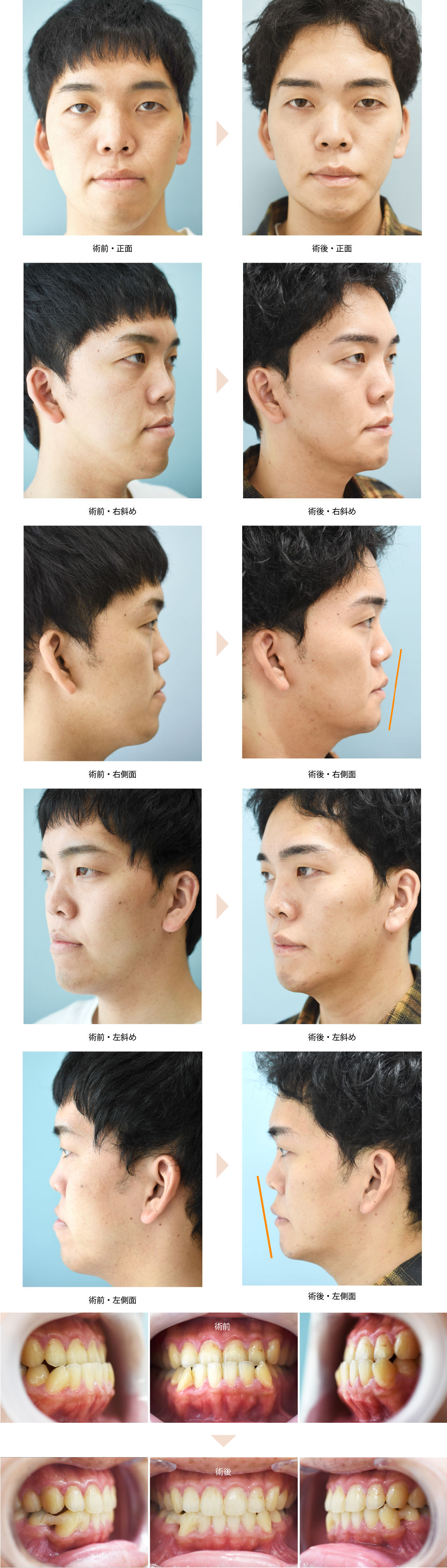 「下顎セットバック＋オトガイ形成（受け口・顎の長さ改善）」の症例写真・ビフォーアフター