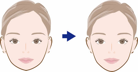 Vライン形成術・小顔整形が適応となる症状