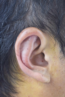 「立ち耳修正（片耳）」の症例写真・ビフォーアフター