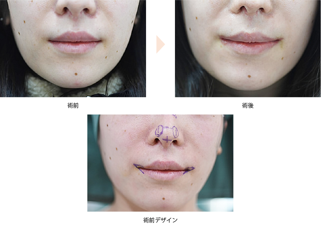「皮膚切除による口角挙上術（スマイルリップ）」の症例写真・ビフォーアフター