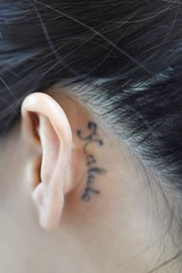「Qスイッチルビー・レーザーによる刺青除去」の症例写真・ビフォーアフター