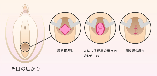 膣粘膜切除法（膣のサイズを縮小するオーソドックスな術法）