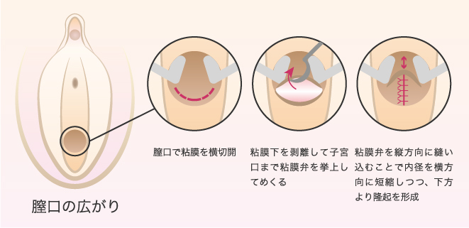 膣粘膜弁法（膣のサイズ＋膣の長さを縮小する術法）