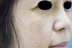 「ピコ美白セット（ピコスポット+ピコトーニング）による日光斑（日光性色素斑）除去」の症例写真・ビフォーアフター