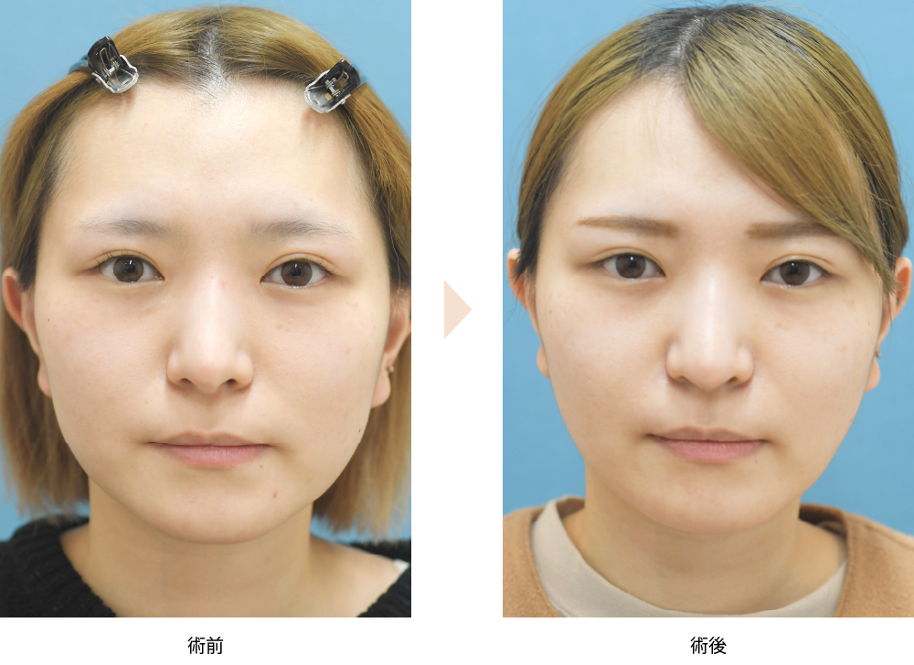 「シルエットリフトと脂肪吸引による小顔整形（若い方の糸リフト症例）」の症例写真・ビフォーアフター