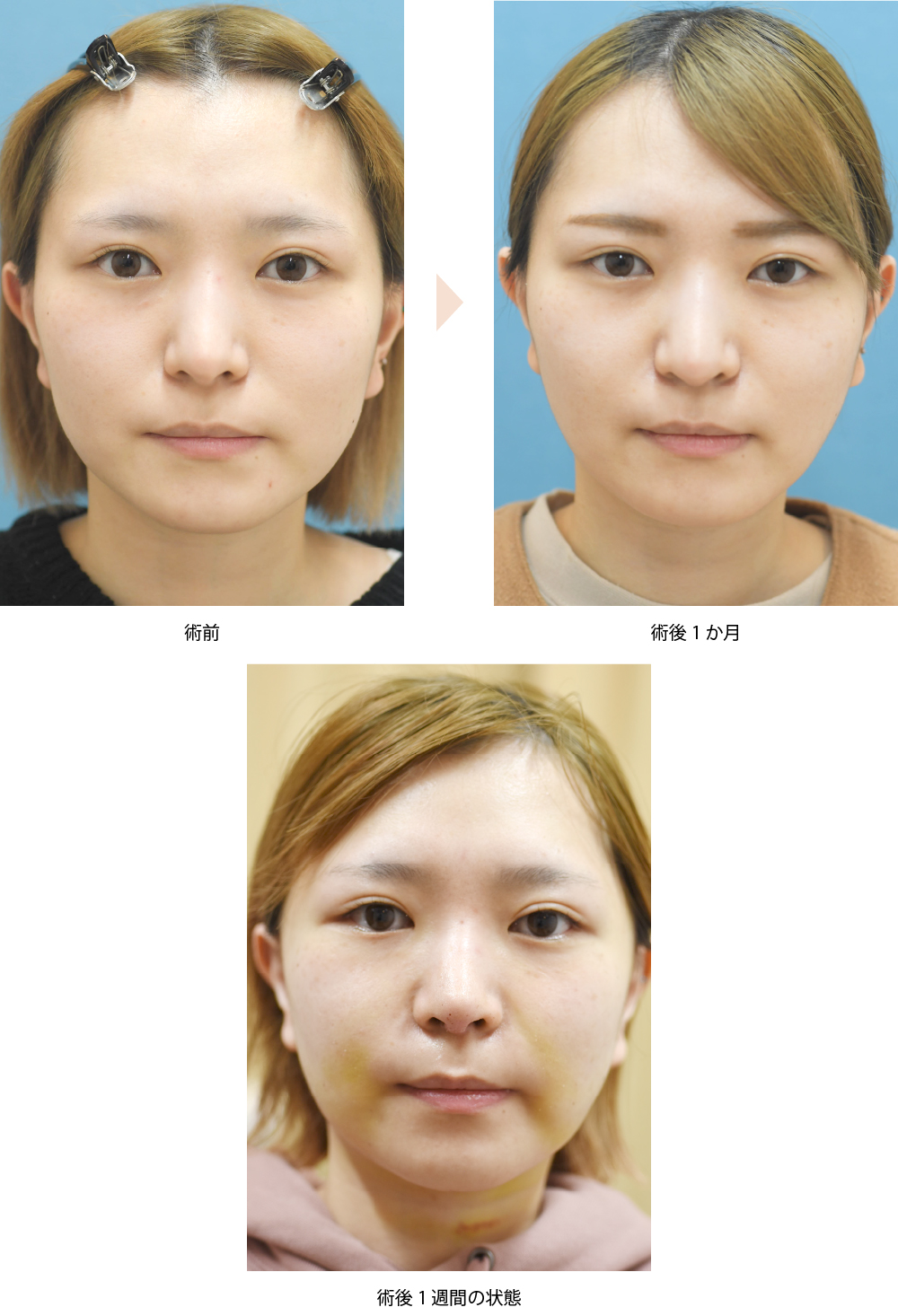 「シルエットリフトと脂肪吸引による小顔治療（若い方の糸リフト症例）」の症例写真・ビフォーアフター