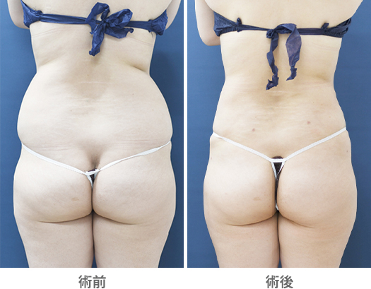 「ベイザー×アキーセル脂肪吸引（腰部）」の症例写真・ビフォーアフター