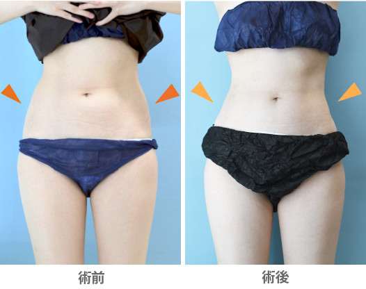 「腰部の脂肪吸引（痩せ型の方でも可能）」の症例写真・ビフォーアフター