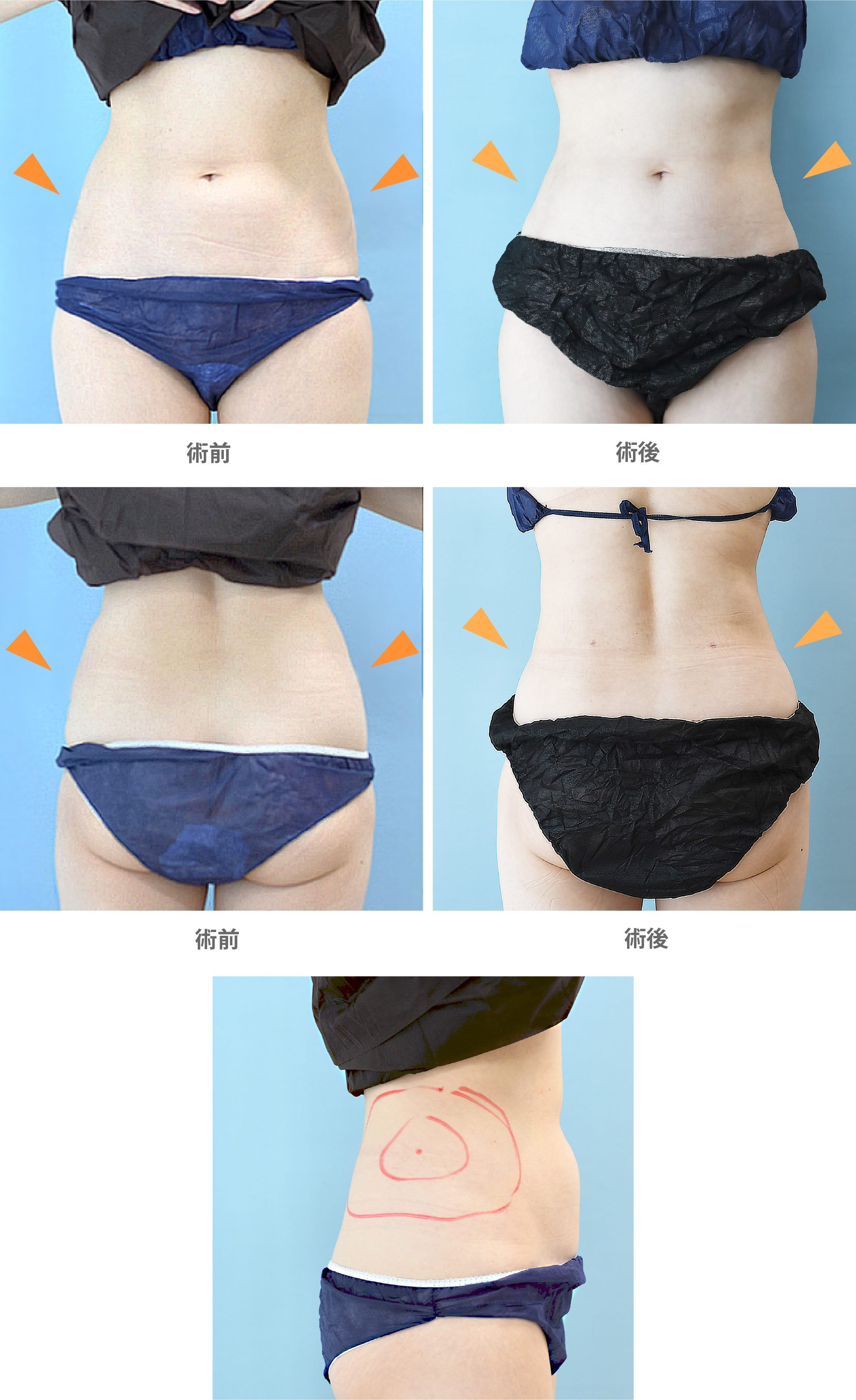 「腰部の脂肪吸引(痩せ型の方でも可能)」の症例写真・ビフォーアフター