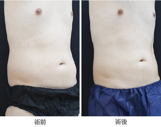 腹部の痩身治療（クルスカ×スカルプシュア）