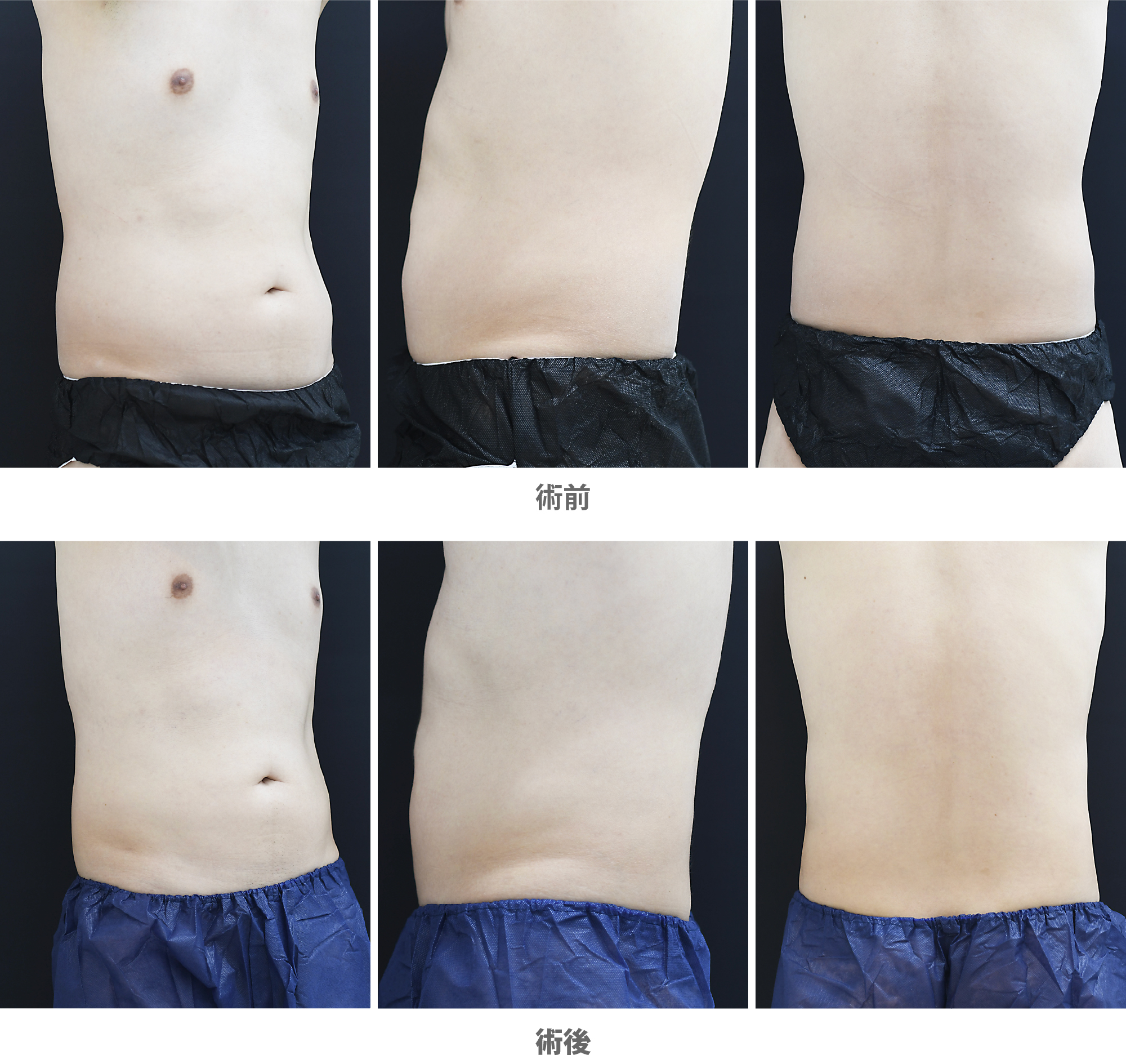 「腹部の痩身治療（クルスカ×スカルプシュア）」の症例写真・ビフォーアフター