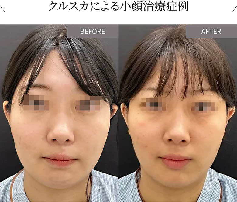 クルスカによる小顔治療症例