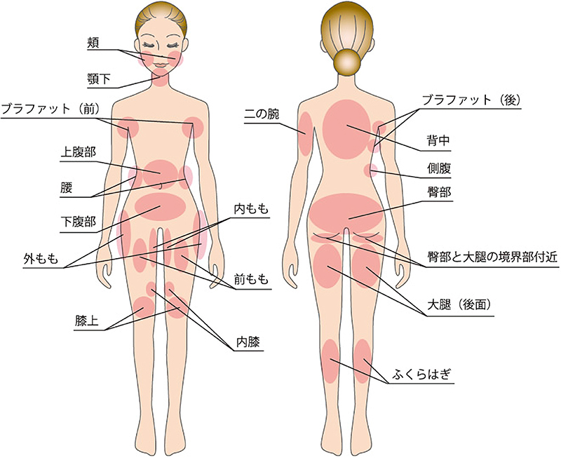 スカルプシュアで脂肪除去が可能な箇所