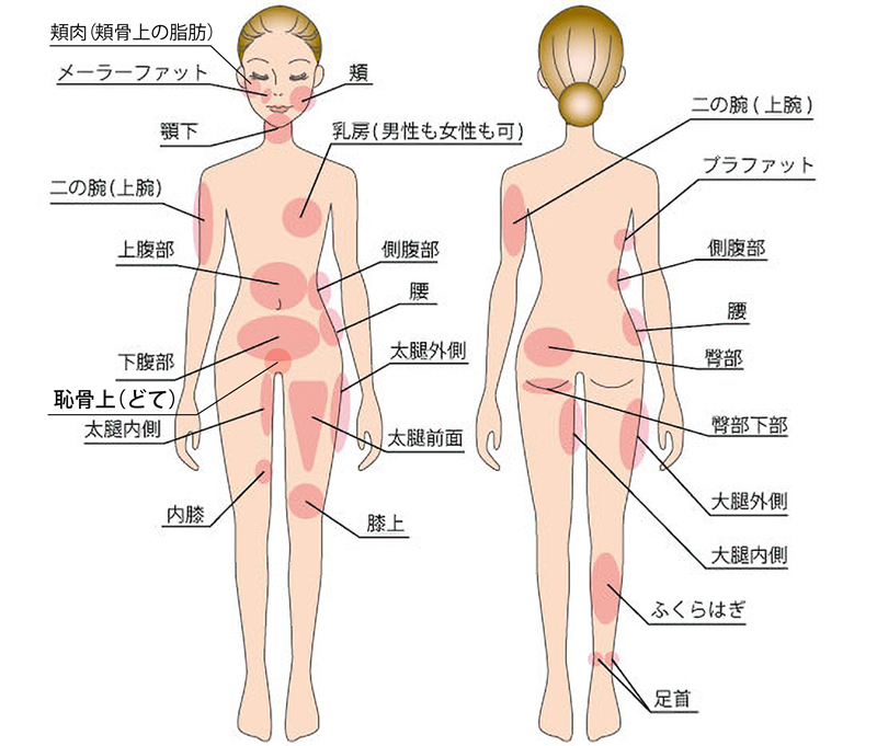 アキーセル脂肪吸引が可能な部位