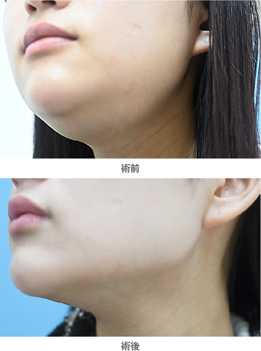「唾液腺ボトックス（顎下のたるみ取り）」の症例写真・ビフォーアフター