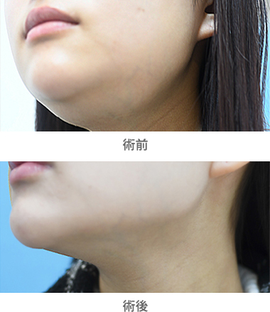 「唾液腺ボトックスによる小顔整形（舌下腺・顎下腺）」の症例写真・ビフォーアフター