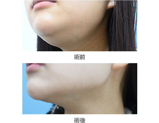 「唾液腺ボトックス（舌下腺・顎下腺）」の症例写真・ビフォーアフター