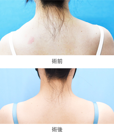 「肩痩せ・肩凝り改善ボトックス注射」の症例写真・ビフォーアフター