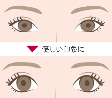 たれ目形成(アーモンドアイ)