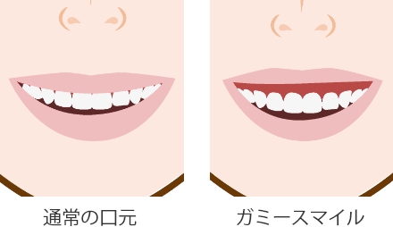 ガミースマイル(上歯茎の露出を軽減)