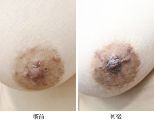「陥没乳頭術の応用（乳頭形成・乳頭再建／乳輪縮小術後に平坦化した乳頭の修正）」の症例写真・ビフォーアフター