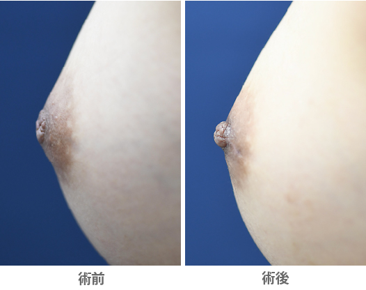 「陥没乳頭治療（保険診料）」の症例写真・ビフォーアフター