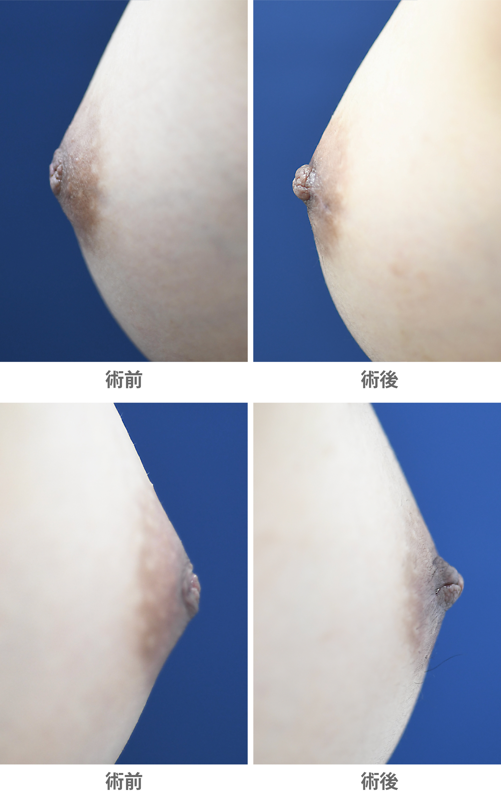 「陥没乳頭治療（保険診料）」の症例写真・ビフォーアフター