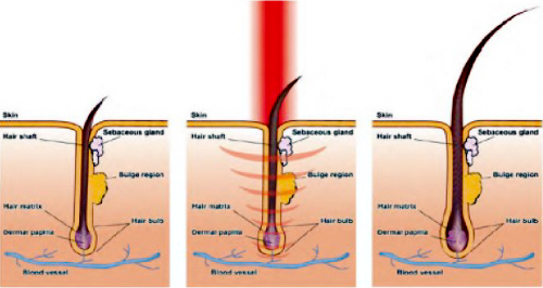 フォトナヘアーによる育毛治療の作用機序