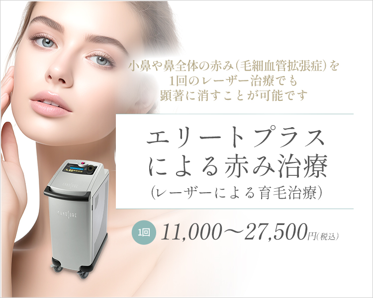 エリートプラスによる赤み治療(小鼻の赤み・血管腫など)